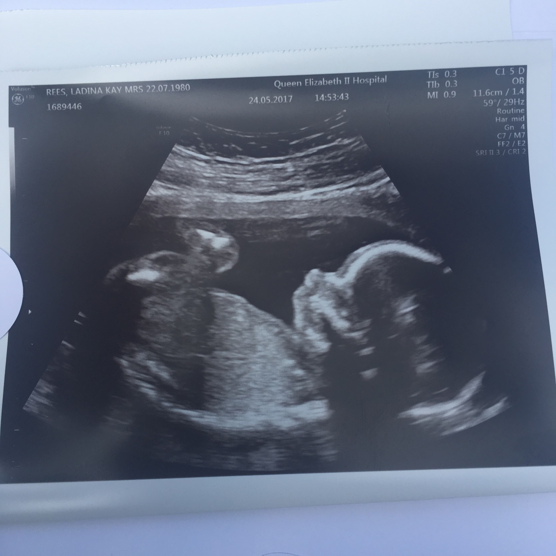 Sonogram of Maisie at 20 weeks and 2 days. 